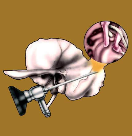 The International Working Group On Endoscopic Ear Surgery