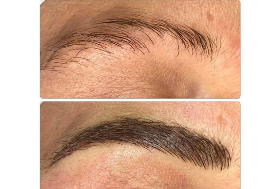 Implante capilar de cejas