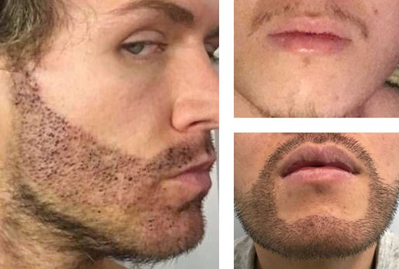 Implante capilar de barba