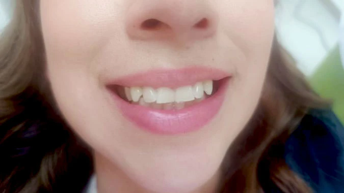 Diseño de sonrisa Diseño de sonrisa