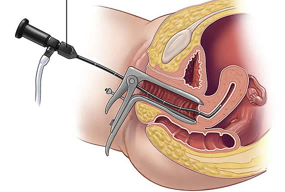 HISTEROSCOPÍA - MAURER 1