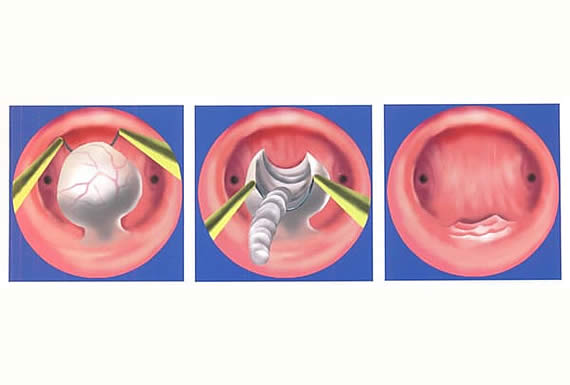 HISTEROSCOPÍA - MAURER 3