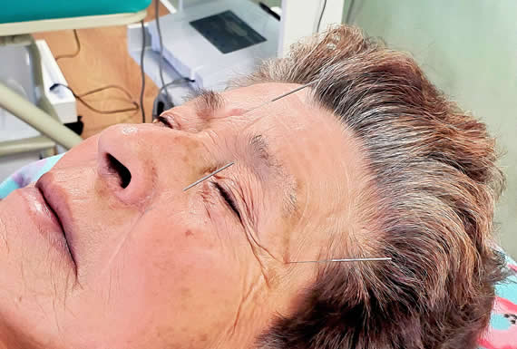 Acupuntura (Terapia complementaria) Acupuntura (Terapia complementaria)