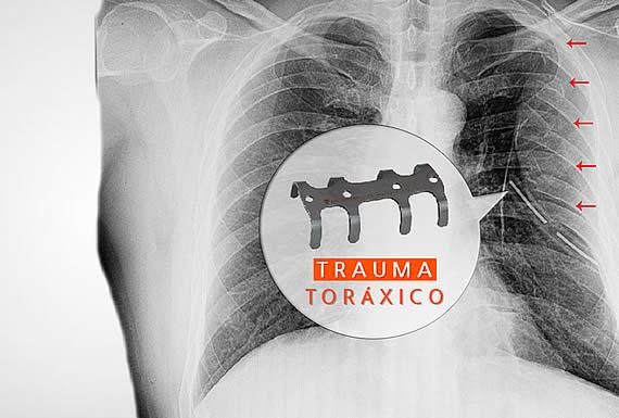 THORAX – SOLUCIONES PARA EL TÓRAX 3