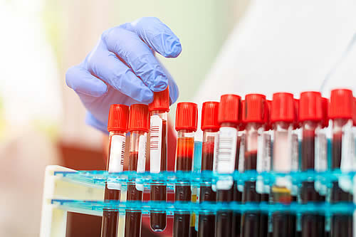 Crean el primer test de sangre que identifica simultáneamente si un paciente tiene cáncer y si se ha propagado 